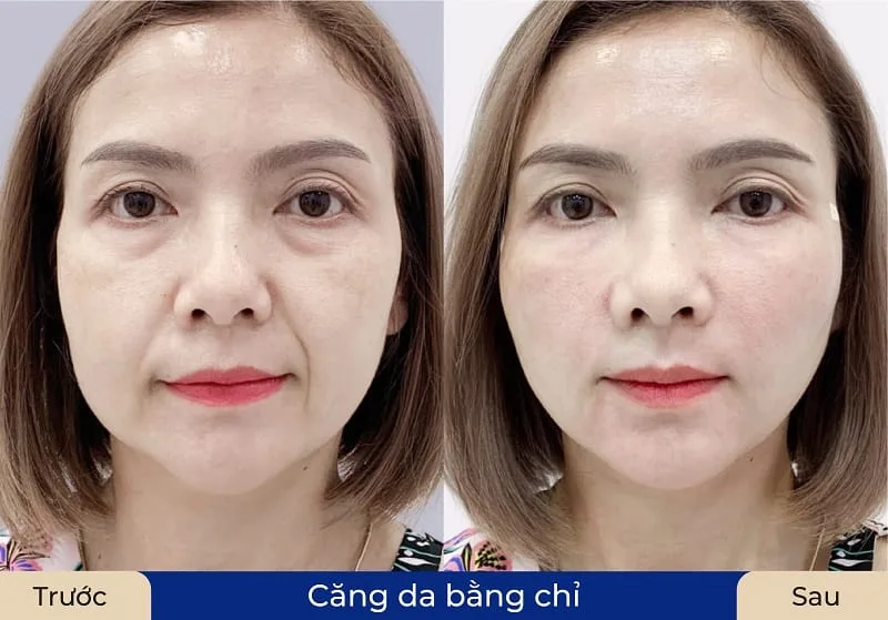 Thời gian duy trì sau căng chỉ khác nhau ở mỗi người vì còn phụ thuộc vào nền da, tuổi tác, loại chỉ và kỹ thuật thực hiện.