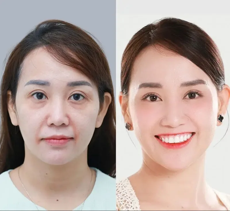 Hiệu quả căng chỉ thay đổi theo từng giai đoạn, từ lúc mới làm đến khi mô mềm ổn định và collagen hình thành.