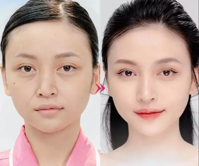 Căng chỉ phù hợp hơn với người có da chảy xệ nhẹ đến trung bình và kỳ vọng thực tế về kết quả.
